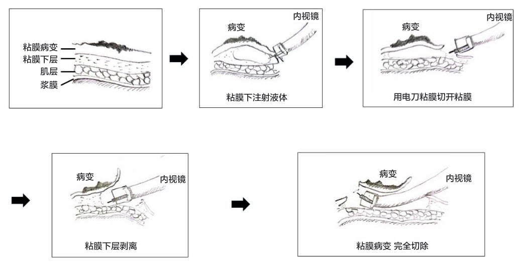 ESD治疗过程