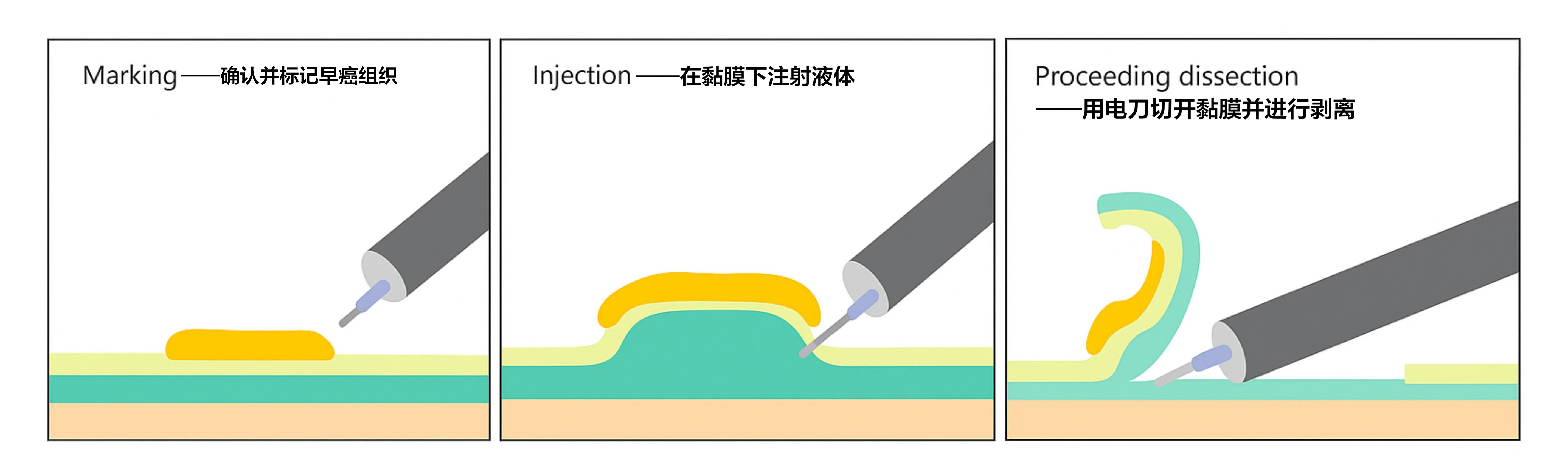 ESD治疗过程