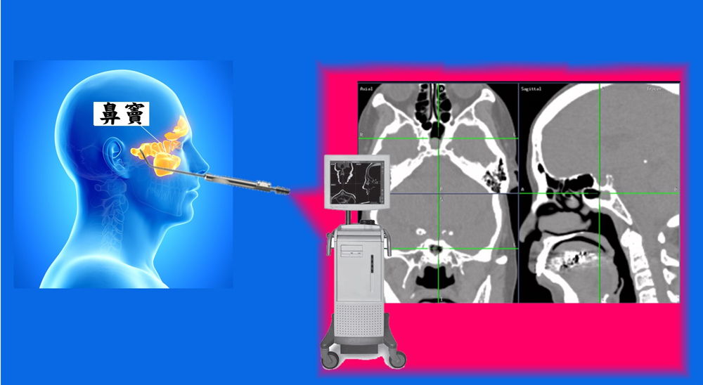 鼻内视镜导航微创手术