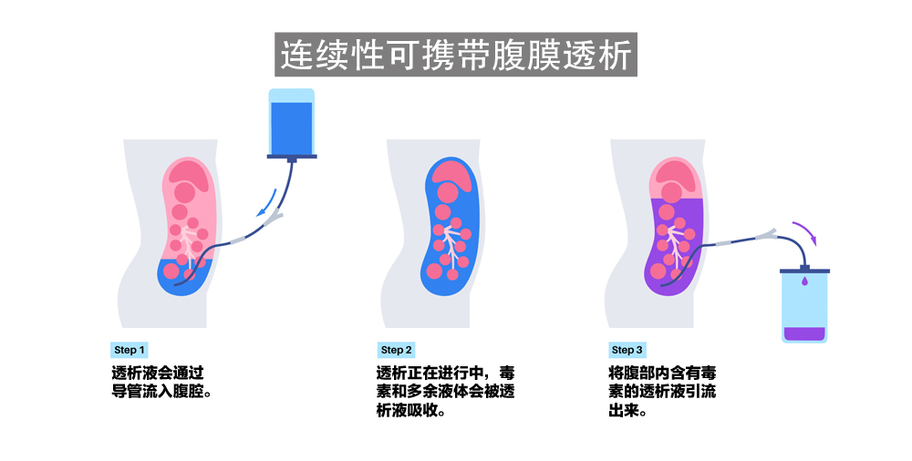 保存残余肾功能 腹膜透析应是优先选择