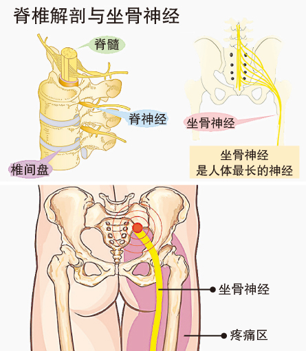 坐骨神经