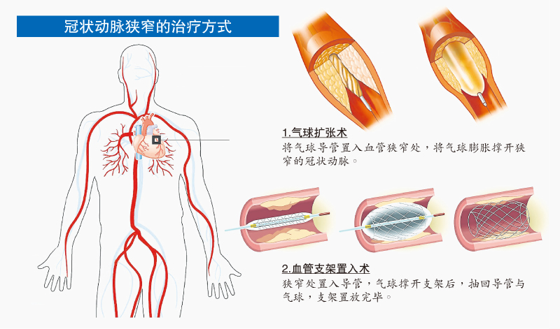 动脉手术