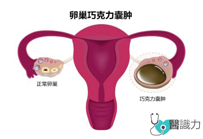 问医, 林韵璇, 反式脂肪, 高糖, 发炎 巧克力囊肿, 卵巢巧克力囊肿, 饮食禁忌, chocolate cyst