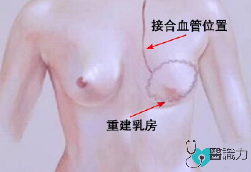 星洲日报，医识力，长庚医院，乳房重建
