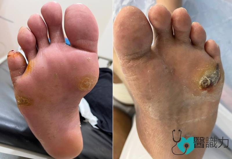 蔡毓彬-鸡眼与茧并非小问题-糖友更要小心防-长期恐引发感染溃疡