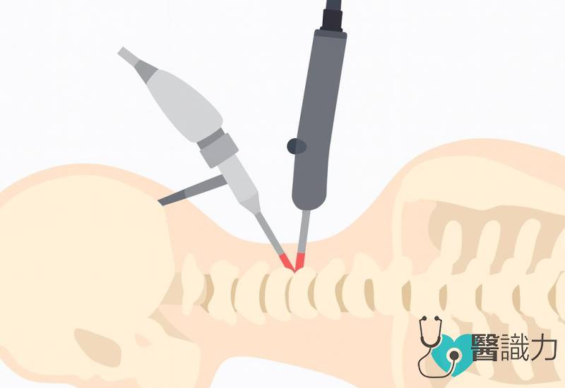 问医-盛晓峰-双孔内视镜微创手术-逆转颈椎弧形-缓解颈臂疼痛