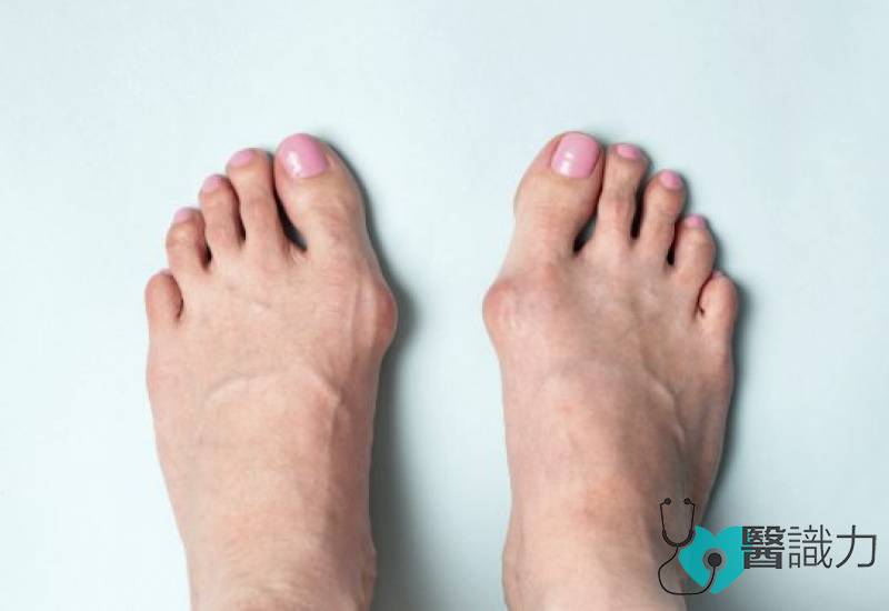 微创矫正拇趾外翻-Minimally Invasive Chevron-Akin-MICA伤口小康复快