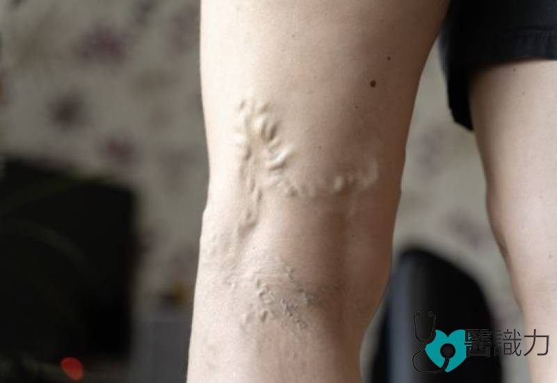 陈楷栋-超级胶水-一封即闭-无需麻醉-20分钟治好-静脉曲张