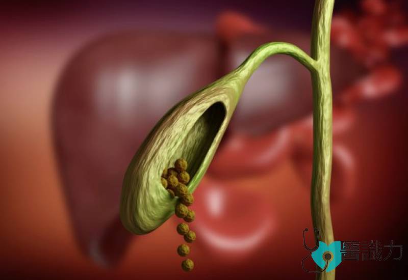 问医, 廖泓睿, 胆结石, 手术, 症状, 并发症, 少喝水, 胆汁浓, gallstones