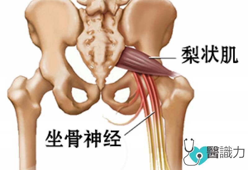 星洲日报，活力副刊，养生，黄东来，梨状肌，坐骨神经，松解痉挛肌肉群，肌肉疼痛，放松，翘脚