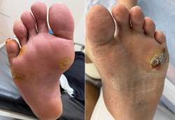 蔡毓彬-鸡眼与茧并非小问题-糖友更要小心防-长期恐引发感染溃疡