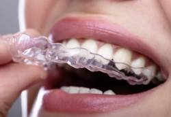 问医, 侯锦泉, 隐形牙套, 传统托槽, 牙齿矫正, clear aligners, braces