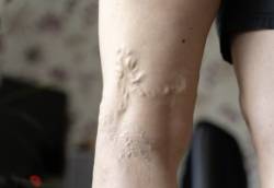 陈楷栋-超级胶水-一封即闭-无需麻醉-20分钟治好-静脉曲张