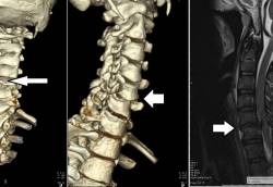 问医-盛晓峰-脊椎伤者勿乱动-错误搬运恐瘫痪